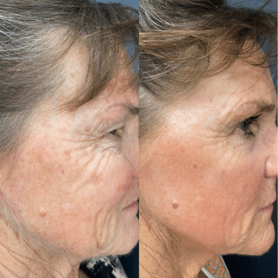 Before & After