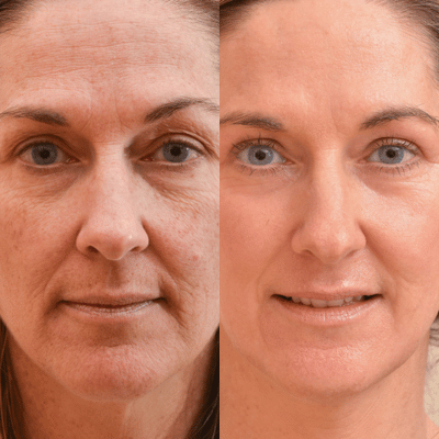 Before & After
