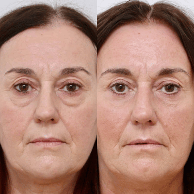 Before & After