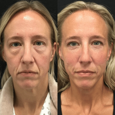 Before & After